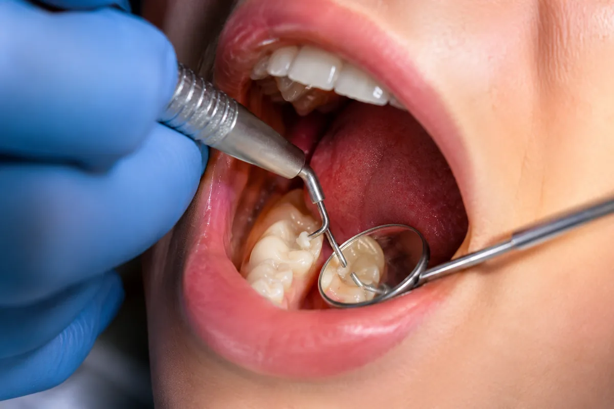 Tooth-coloured composite fillings at Long Lake Family Dentistry