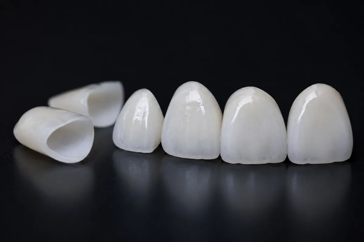 Porcelain veneers consultation at Long Lake Family Dentistry