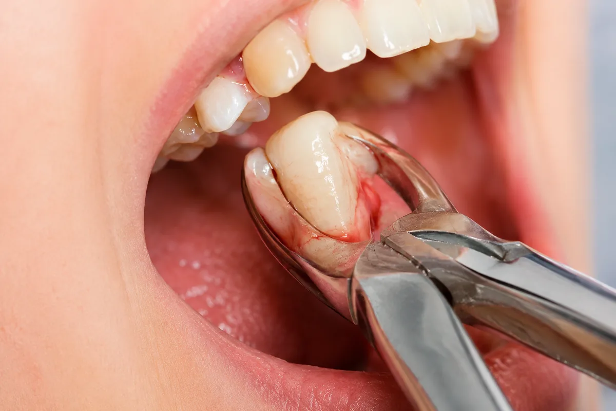 Tooth extraction at Long Lake Family Dentistry